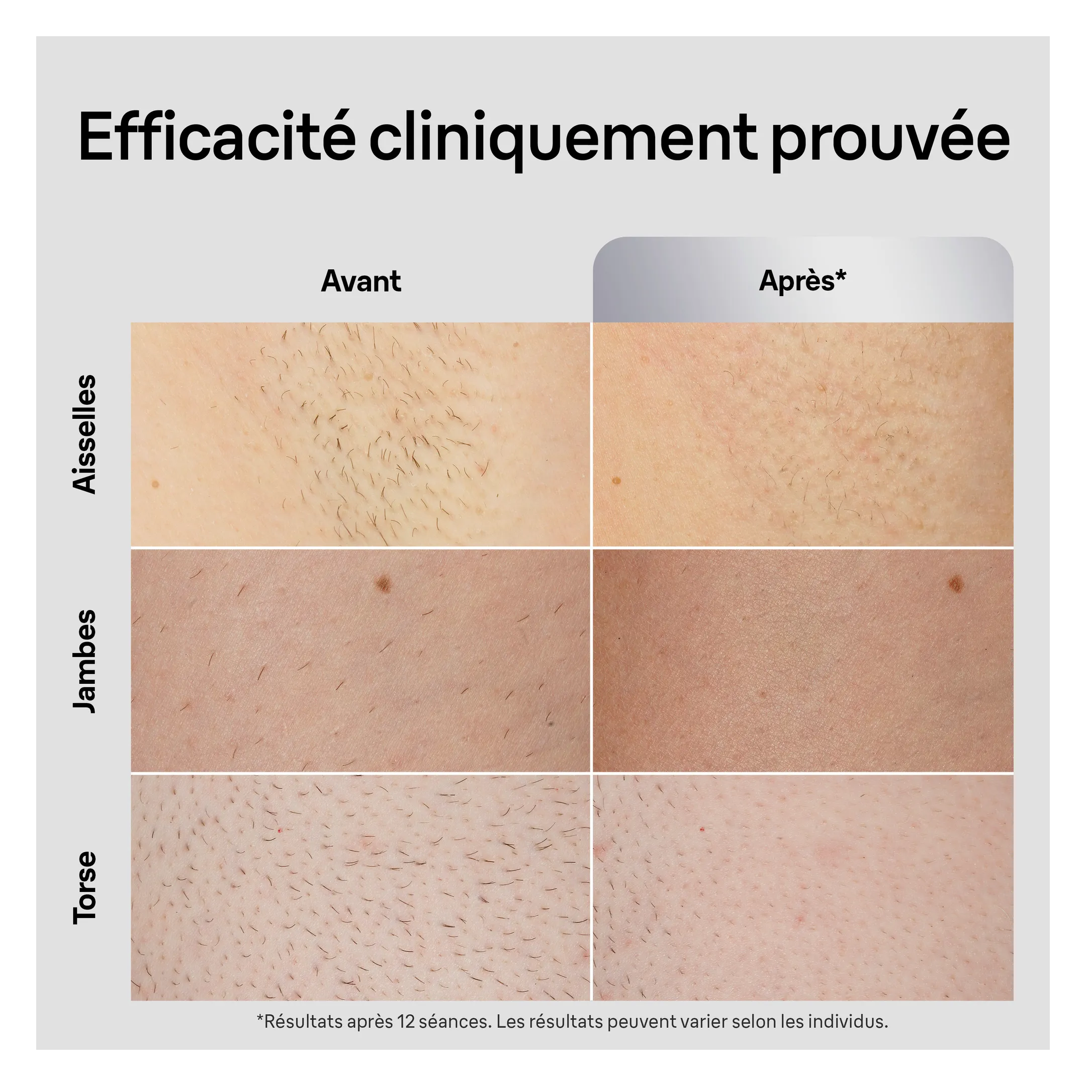 Braun Épilateur À Lumière Pulsée Silk·expert Pro 5, Avec Pochette, Rasoir Gillette, 2 Têtes, PL5145 image