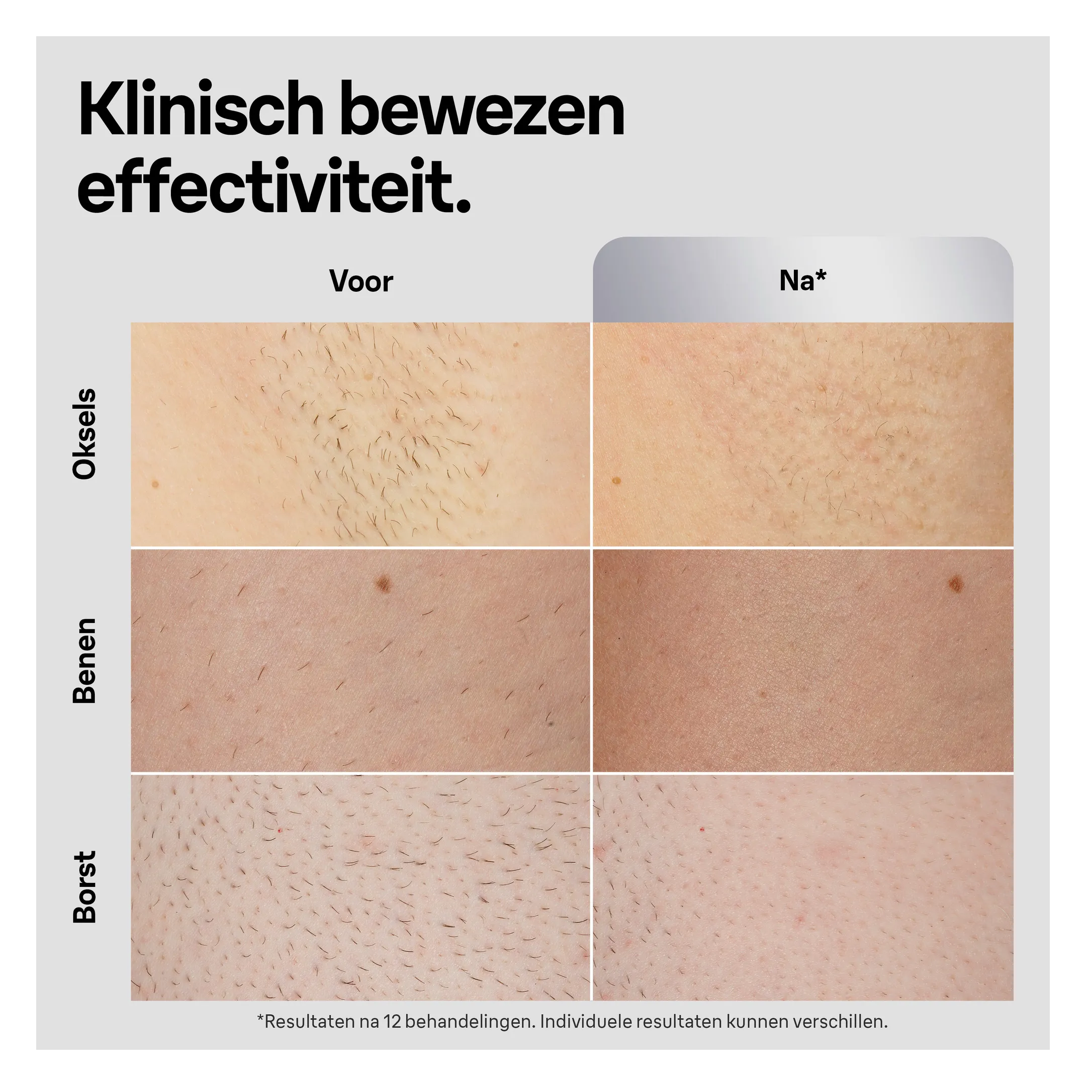 Braun IPL Silk-expert Pro 5, ontharing voor thuis, Etui, Gillette-scheermesje, 2 koppen, PL5145 image